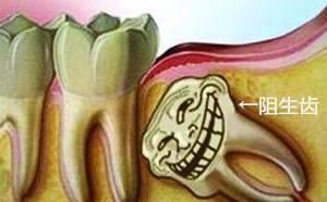 长智齿（尽头牙）了怎么办？以及拔牙后注意事项
，长尽头牙痛怎么办？图2
