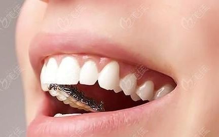 矫正牙套有几种材料？
，牙齿矫正一般带牙套都要带多久呀？
